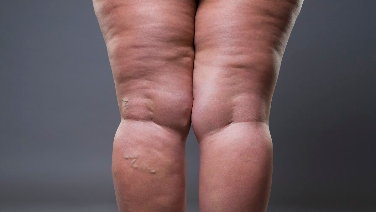 Expertise em Lipedema